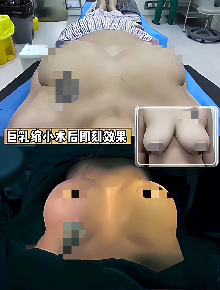 巨乳缩小整形案例-1